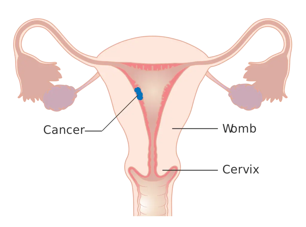 Stage 1 choriocarcinoma