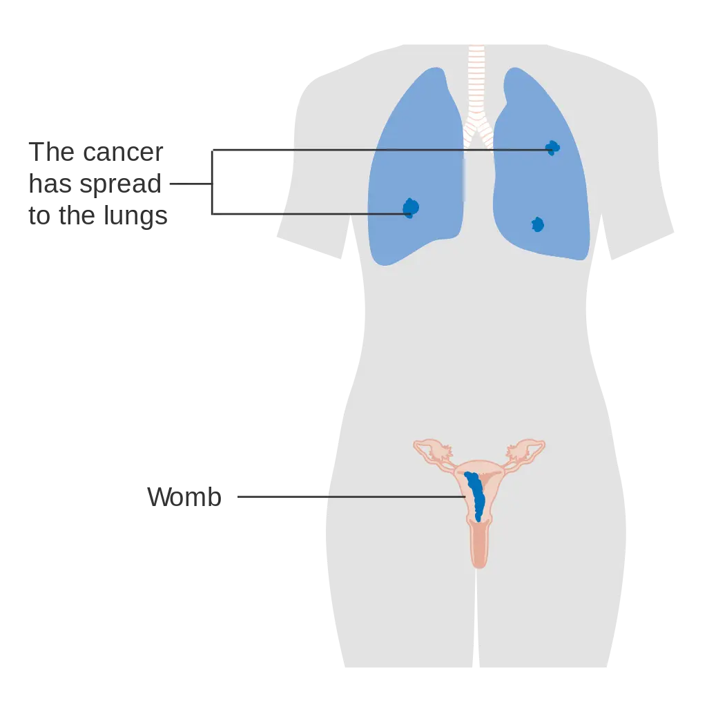 Stage 3 choriocarcinoma