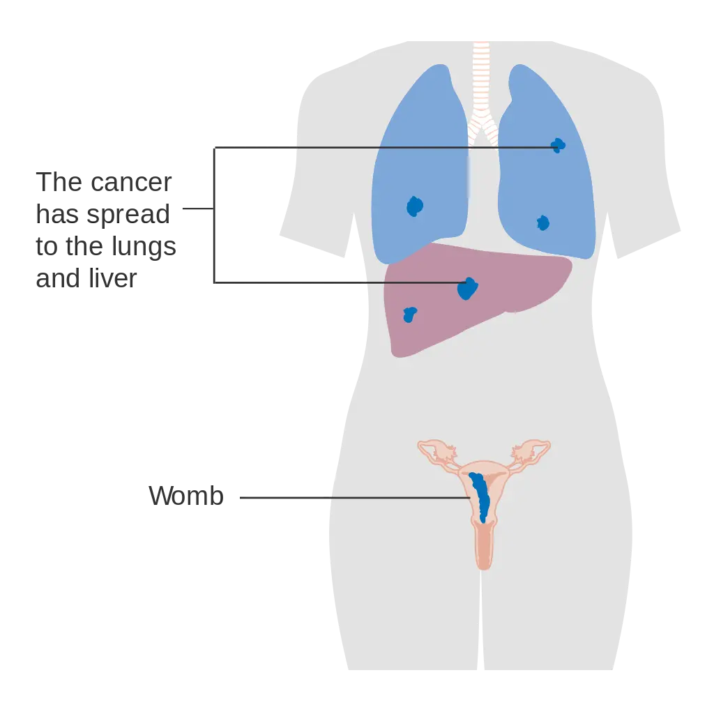 Stage 4 choriocarcinoma