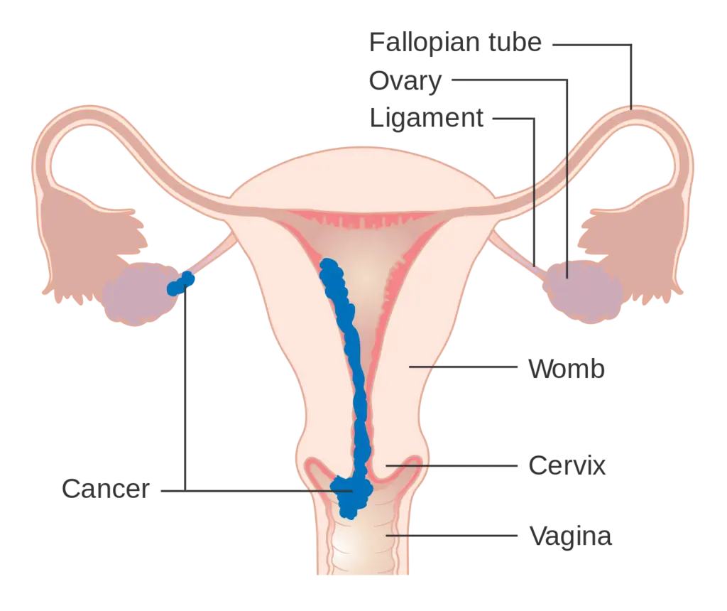 Stage 2 choriocarcinoma